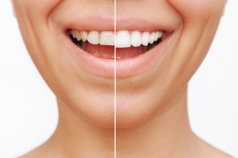 Vergleich zwischen normalen Zähnen und Veneers